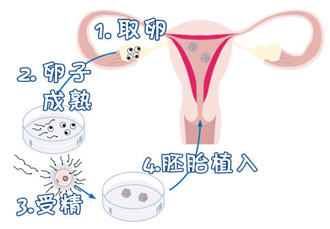 高龄二胎案例